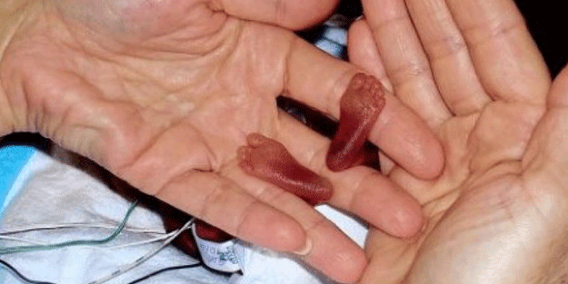 Dünyanın en küçük bebeğiydi! Son hali şaşırttı