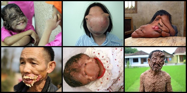 Dünyanın en tuhaf hastalıkları - FOTO