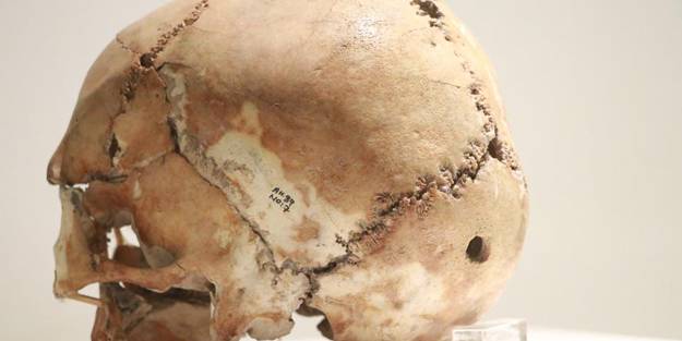 Dünyanın ilk beyin ameliyatı 10 bin 500 yıl önce Aksaray’da yapıldı