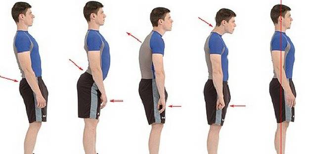 Duruş bozukluğu skolyoz işareti olabilir