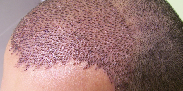 Duyanlar Türkiye planı yapıyorlar: Küresel saç ekiminin adresi oldu! Beklenmedik plana hizmet, 52 milyar dolar