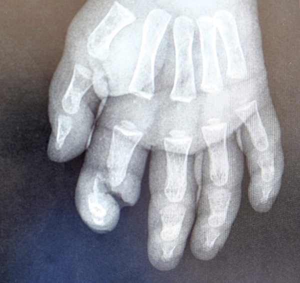 Ebeveynler dikkat! Acil servislere bu şikayetle başvuruluyor