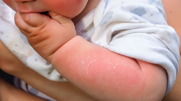 Ebeveynler dikkat! Bu hata ileriki yaşlarda cilt kanserine yol açıyor