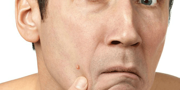 Eğer çıkan sivilce yüzünüzün bu bölgesindeyse aman dikkat! Hangi bölgede çıkıyorsa o hastalığın habercisi