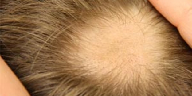 Egzama, eklem iltihabı ve saçkırana 