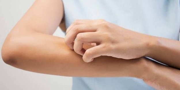 Egzama Nedir, Ne İyi Gelir? Egzama Nedenleri ve Belirtileri