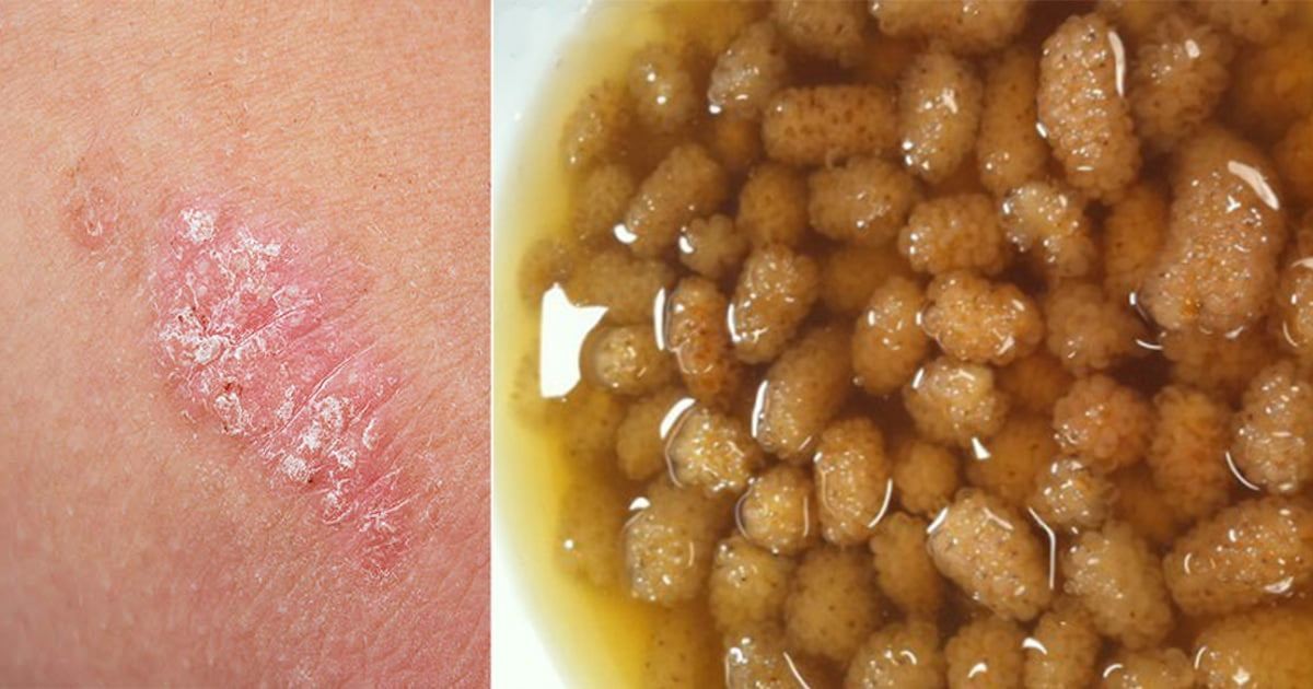 Egzamadan kurtaran en iyi doğal tedavi ne? Egzama ve kepek sorunu yaşayanlar bu defa her gece yapsın