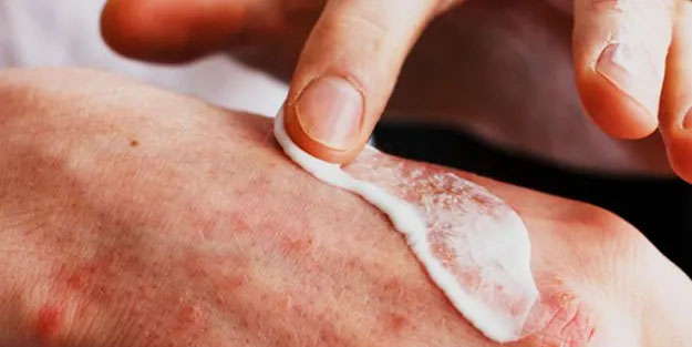 Egzamaya ne iyi gelir? Egzama, mantar ve sedefin kökünü kazıyor...