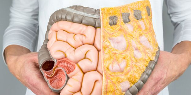 Egzersizde salınan protein bağırsak (kolon) kanserinden koruyor! Kolon kanseri belirtileri