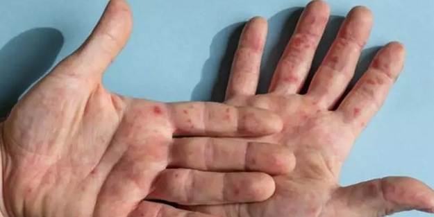 El, ayak ve ağız hastalığı uyarısı! Uzman duyurdu: Maalesef geri geldi! Havuz suyundan bulaşabilir! Ne yapılacak?