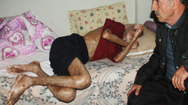 Elazığ'da nakil sonrası vücudunda yaralar çıktı, gözlerini kaybetti