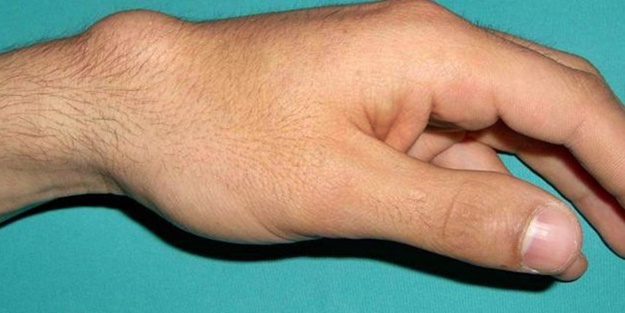 Elde neden kist çıkar? Bu kist zararlı mıdır?