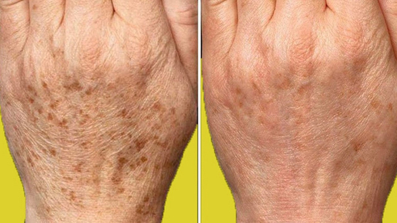 Eldeki lekeleri silgi gibi silen mucize kür: Şansımız var!