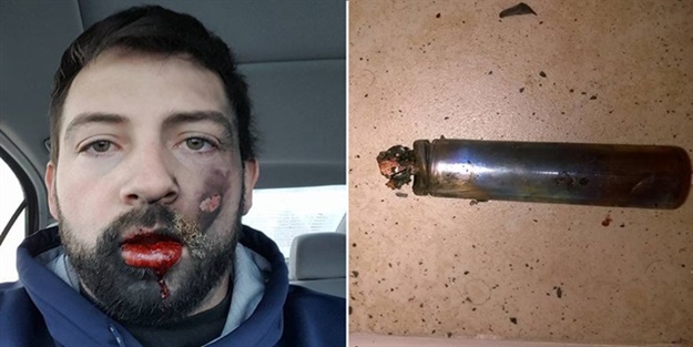 Elektronik sigara patladı, yedi dişini kaybetti