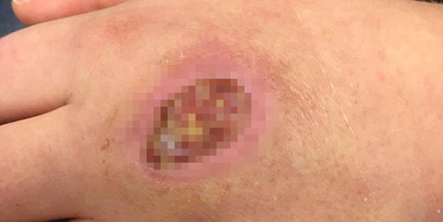 Elinde delik açıldı