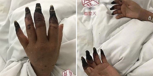 Elindeki ufak yara nedeniyle az kalsın 8 parmağını kaybediyordu