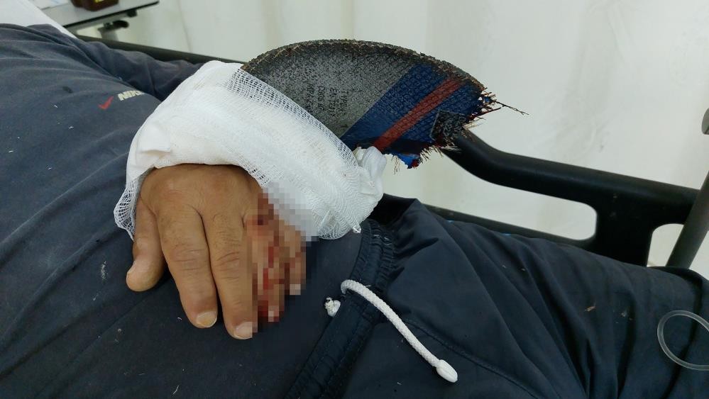 Eline saplanan spiral taşıyla hastaneye geldi