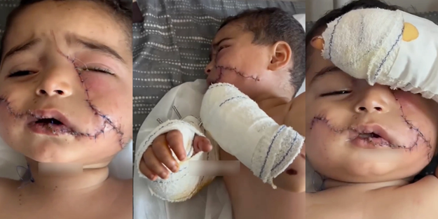 Elinin ve dilinin bir kısmını kaybeden Gazzeli bebek! Gören insanlığından utanıyor