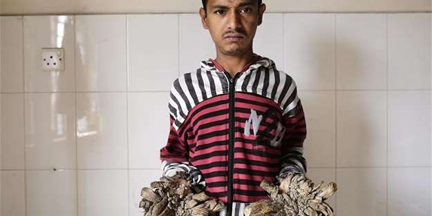 Elleri ve ayakları ağaca dönüşüyor!