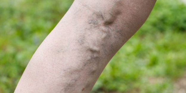 Elma sirkesi ile varislerden kurtulun!