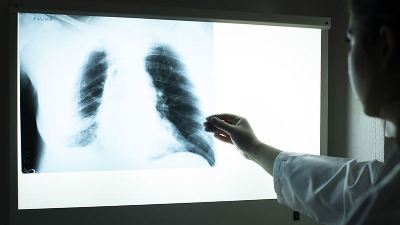 En büyük tehdit sigara! Her yıl 30 bin kişide görülüyor