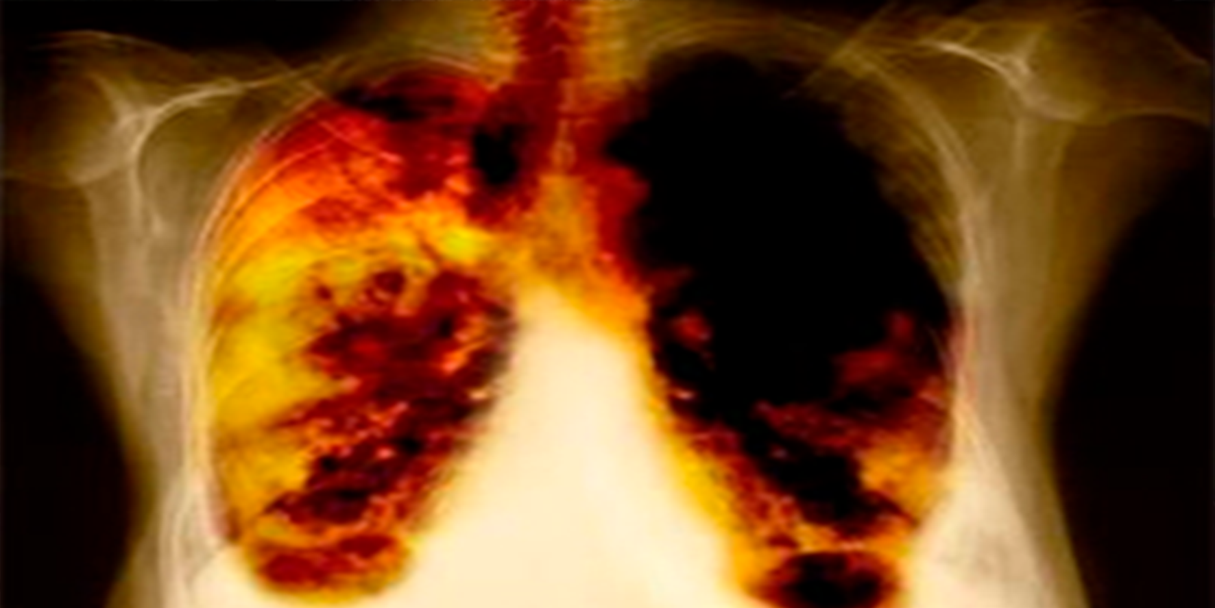 En ölümcül kanser türüne dikkat! O bulgular akciğer kanseri belirtisi olabilir!