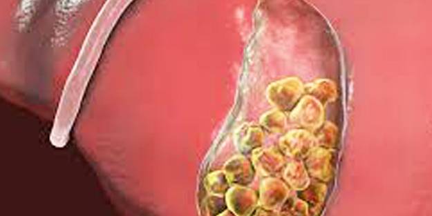 En önemli belirtisi karın ağrısı