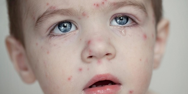 En tehlikeli bulaşıcı hastalık: Kızamık