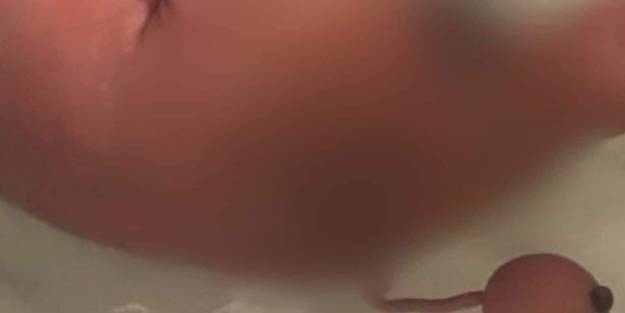 Erbakan'ın sözlerini akıllara getirdi... Bilim dünyası şaşkın: Kuyruklu bir bebek dünyaya geldi