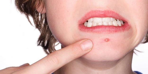 Ergenlik sivilcesi nedir? | Ergenlik sivilcesi nasıl tedavi edilir?