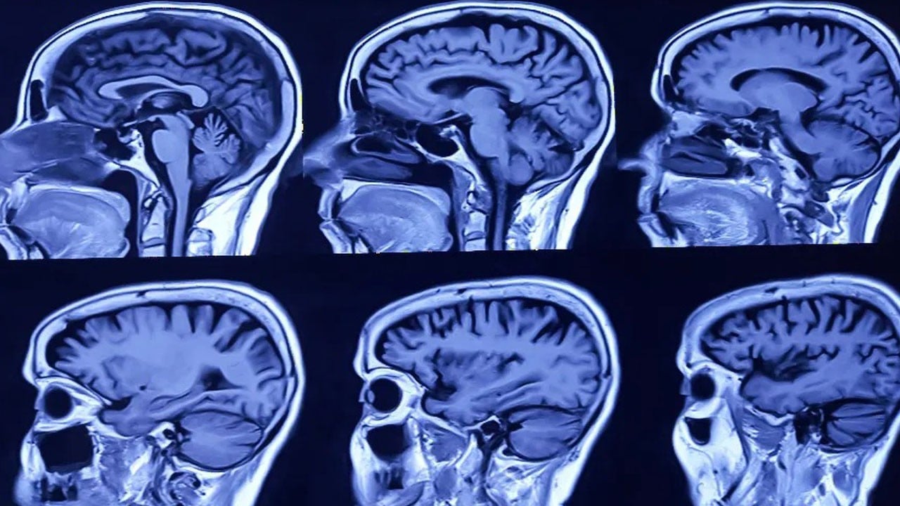 Erken müdahale hayatı değiştiriyor! Genç yaşta başlıyor, sinsice ilerliyor