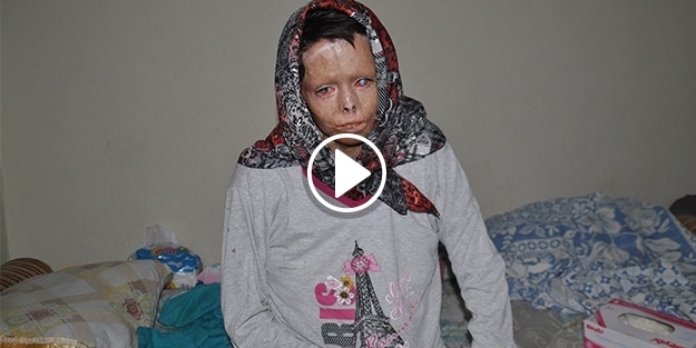 Esed'in yaktığı Nuha, Türkiye'de şifa buluyor