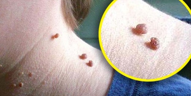 Et benlerinden doğal yöntemlerle kurtulun!