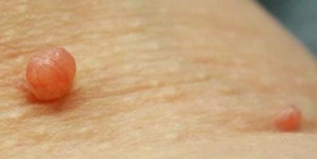 Et benlerinden kurtaran yöntem