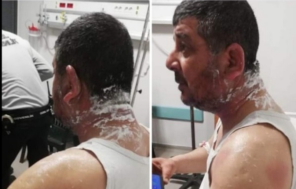 Ev sahibi kiracısına asitle saldırdı