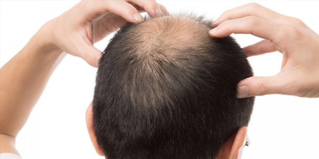 Eyvah! Meğer o içecekler kelliğe neden oluyormuş!