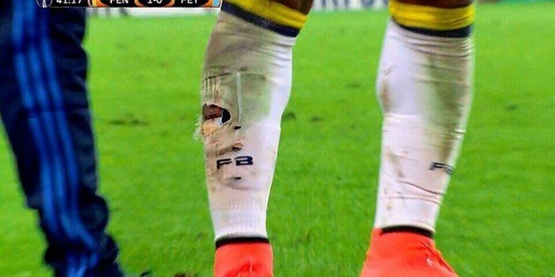 Fenerbahçeli yıldızın bacağı bu hale geldi!
