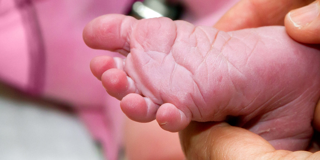 Fenilketonüri nedir? Çocuklarda zeka geriliğine neden olan fenilketonüri hastalığı belirtileri