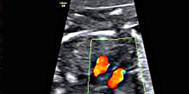 Fetal ekokardiyografi çok önemli!