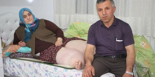 Fil hastalığı nedeniyle 4 yıldır evden çıkamıyor