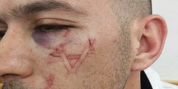 Filistinli gencin yüzüne metal bir alet ile 'İsrail bayrağı' kazıdılar!