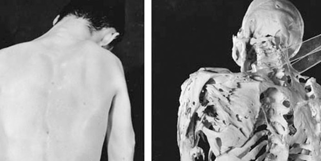 FOP hastalığı hangi sıklıkta görülmektedir?