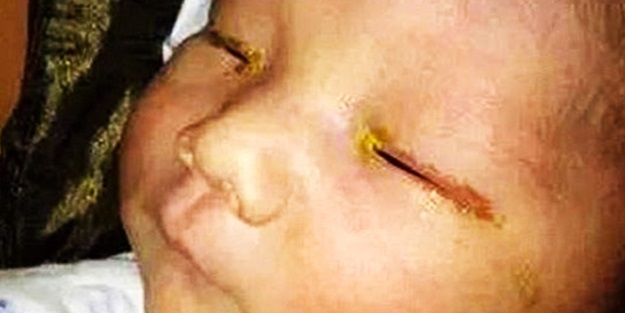 Fotoğrafı çekilen bebek gözünü kaybetti