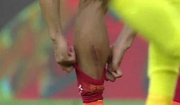 Galatasaraylı yıldızın bacağı bu hale geldi!