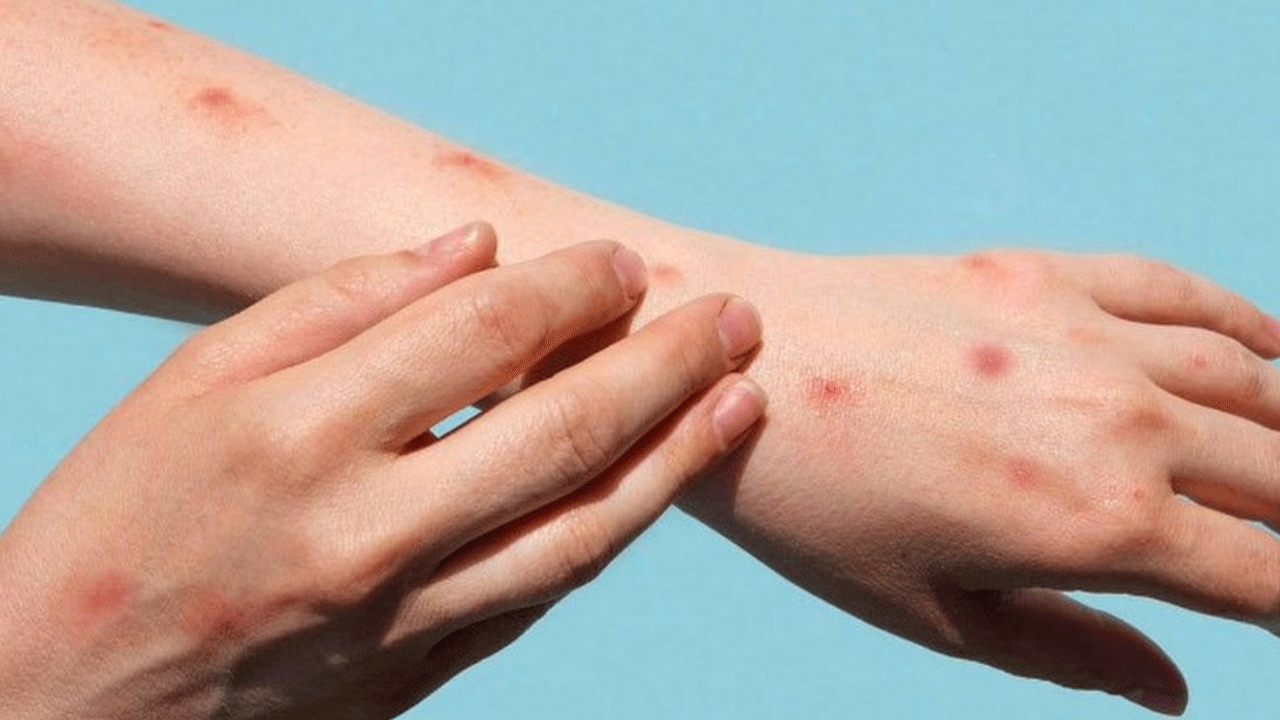 Gana'dan dünyayı korkutan haber! M çiçeği vaka sayısı arttı