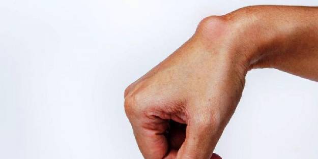 Ganglion kisti daha çok kadınlarda görülüyor