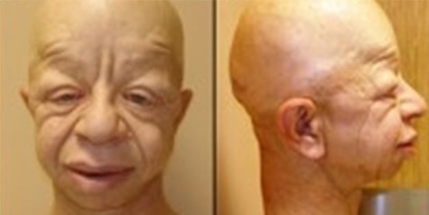 GAPO sendromu nedir?