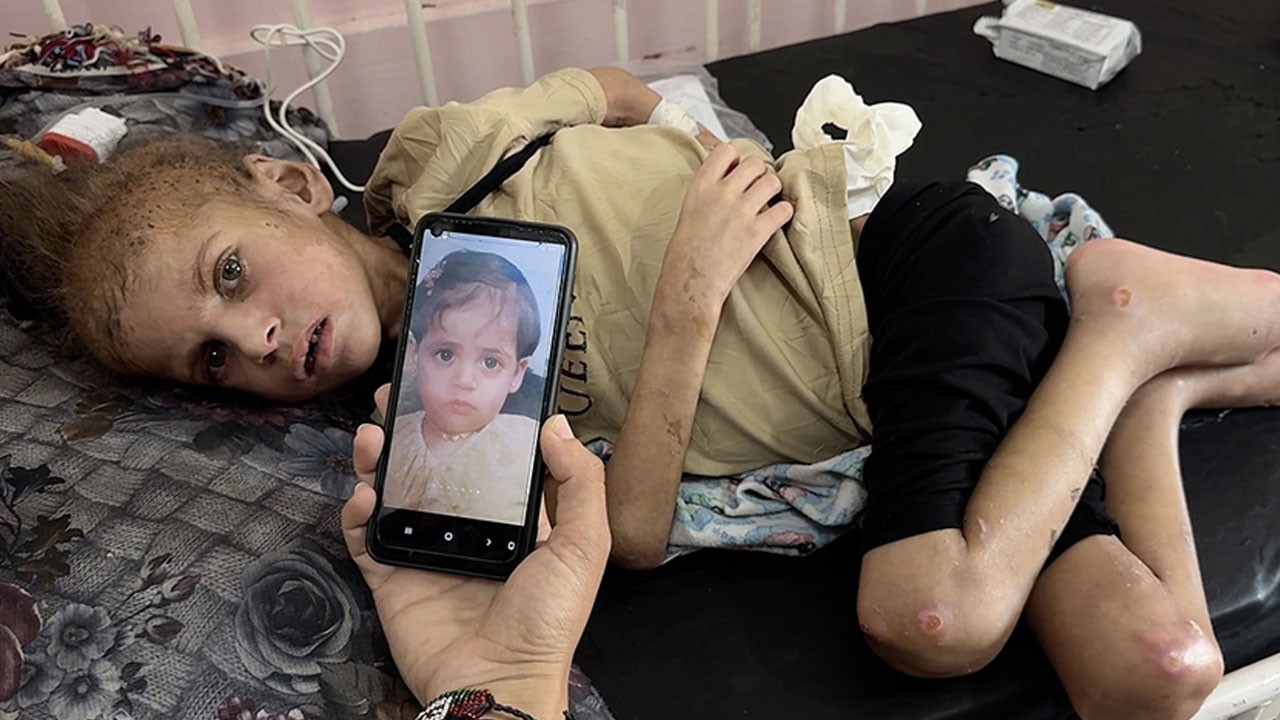 Gazze’de açlığın simgesi! 7 yaşında artık yürüyemiyor