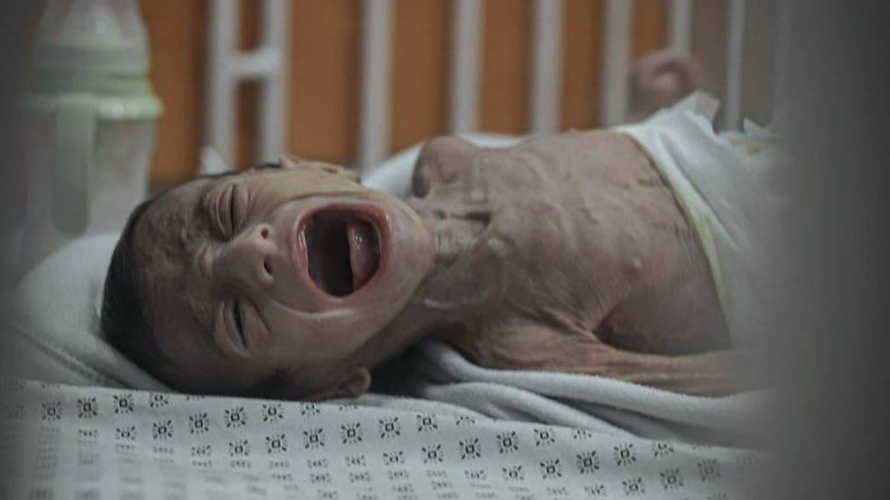 Gazze'de açlıktan ölenlerin sayısı 263'e yükseldi!