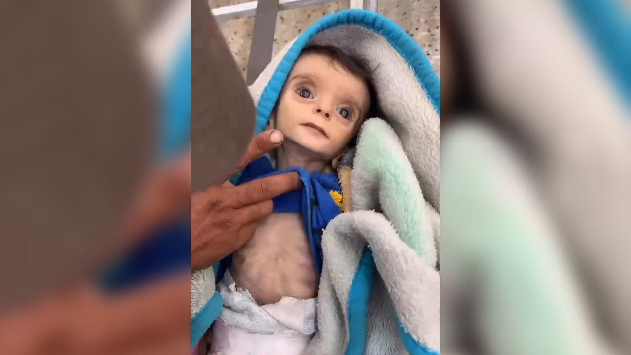 Gazze'de açlıktan ölenlerin sayısı 453'e yükseldi